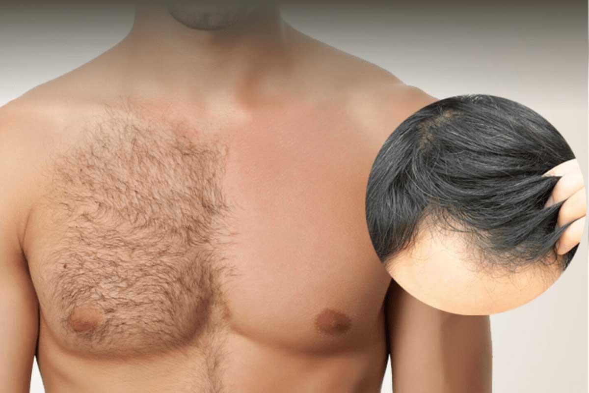 أسباب كثرة الشعر في الجسم عند الرجال
