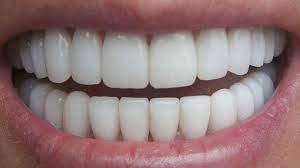 هل يمكن تبديل الأسنان مرتين