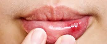 هل فطريات الفم خطيرة